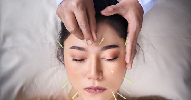 Cosmetic Acupuncture